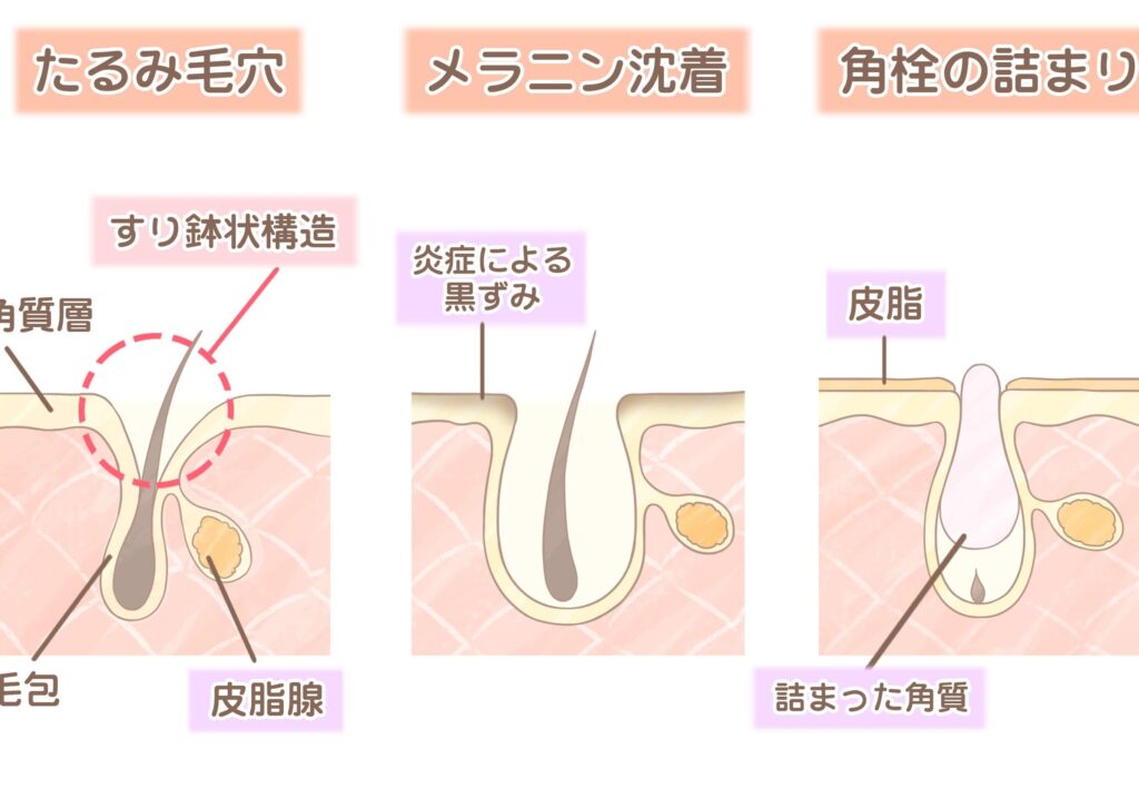 毛穴はなぜ開く？原因と対策を徹底解説