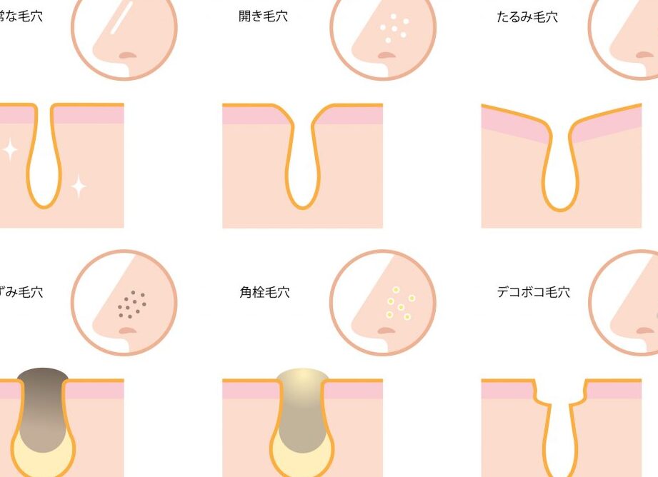 毛穴開いてる理由と改善方法まとめ