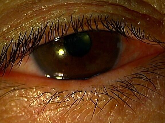 瞳孔を開く目薬はいつまで効果が持続するか