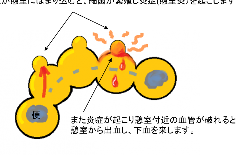 腸に穴が開いたら入院期間はどのくらいか解説